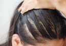 What Are Some of the Most Common Causes of Hair Loss?